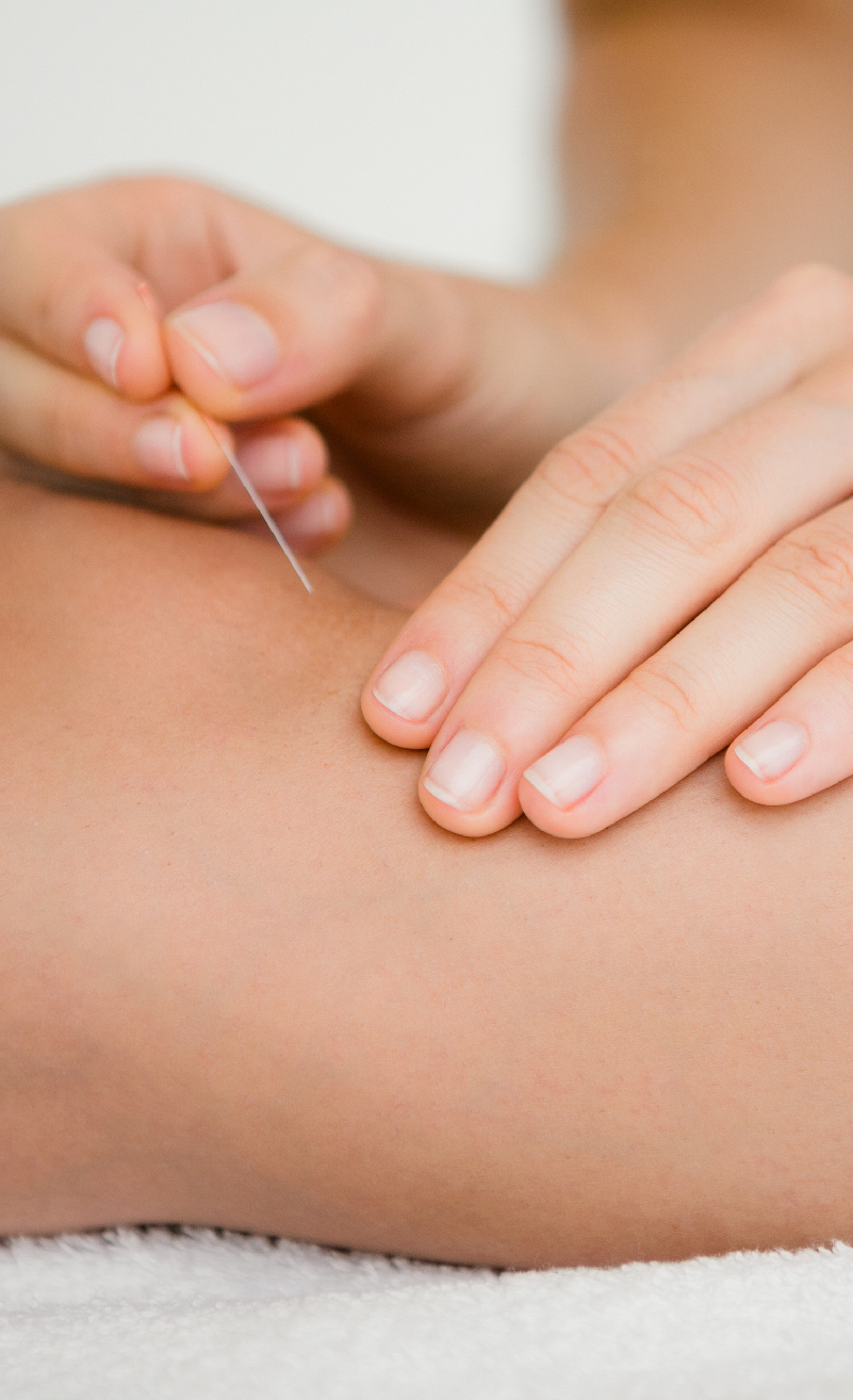 acupuncture & dry needling